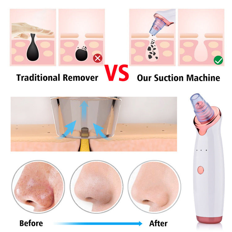 Blackhead Vacuum Remover